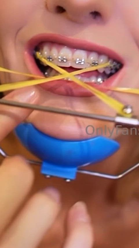 braces petite small tits braceface clip
