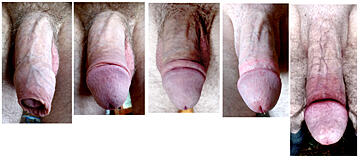 My penis in 5 stages